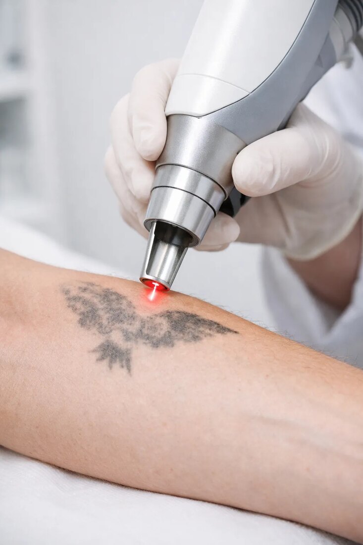 Laser handpiece treating a tattoo on a forearm at the Tattoo Removal Prague studio
